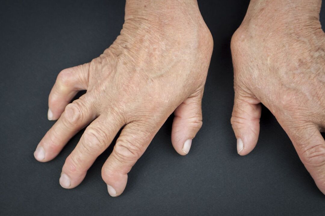 Ουρική αρθρίτιδα των χεριών